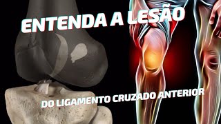 Entenda a Lesão do ligamento cruzado anterior!