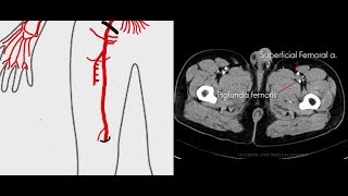 Arteries of Lower Limb + CT anatomy