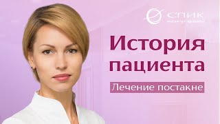 История пациента: лечение постакне