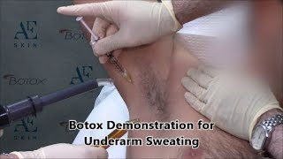 Botox Demonstration 25 Underarm Sweating - A E Skin - Encino, CA - 818-835-1833