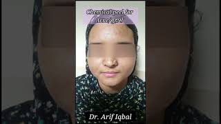 Chemical peel for acne /मुहासे