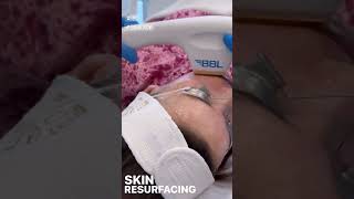 BBL Treatment for Skin Resurfacing | Achieve Radiant, Smooth Skin at EDEN AESTHETICS Clinic, Dubai