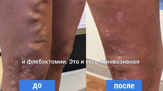 У ВАС ВАРИКОЗНОЕ РАСШИРЕНИЕ ВЕН? УЗНАЙТЕ О ЛЕЧЕНИИ / Varicose veins