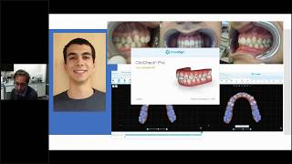 Invisalign chiusura diastemi