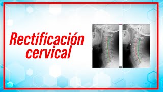 Rectificación cervical: síntomas, causas y como tratarla