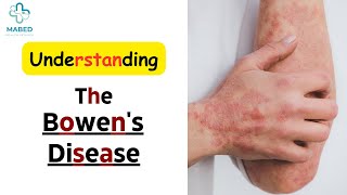 Bowen's Disease Causes, Effects, Symptoms, Treatments, and Ayurvedic Approach