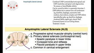 Sandra Bullock's partner, Bryan Randall, died of Amyotrophic Lateral Sclerosis (ALS). What is ALS?