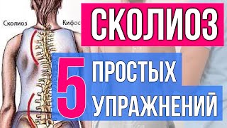 Лечение сколиоза без операции. Топ 5 упражнений. [Упражнения от сколиоза]