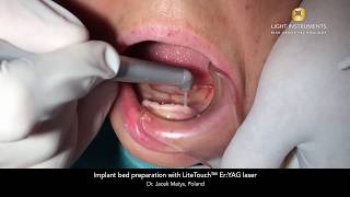 Implant bed preparation with LiteTouch™ Er:YAG Laser