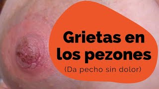 GRIETAS EN LOS PEZONES(remedio natural) no más dolor 2020