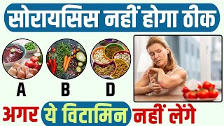 कौन सा Vitamin करेंगे सोरायसिस को ठीक | Psoriasis Increases In Summer | सोरायसिस का जड़ से इलाज