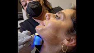 Exilis Ultra for Jawline Contouring