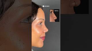 Before and 3 weeks after Closed Scarless Rhinoplasty | Dr. med. Simon Zimmermann