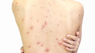 How to Treat Chickenpox and Fade Its Scars