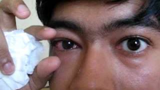 #Conjunctivitis of Right eye l #Pinkeye