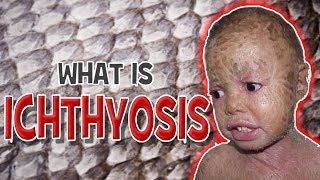 What is Ichthyosis - Cause, Symptoms & Treatment