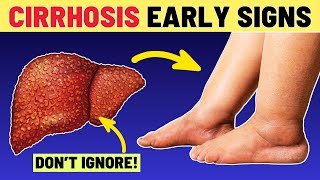 Never Ignore These 12 Early Warning Signs of Liver CIRRHOSIS | VisitJoy