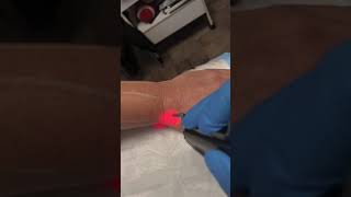 Laser hair removal on arms, finger and hands on a female