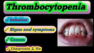 thrombocytopenia | causes | symptoms | diagnosis | treatment