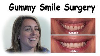 Gummy Smile Surgery - Bergen County NJ Dentist