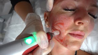 MY FIRST MICRONEEDLING EXPERIENCE // WHAT TO EXPECT | Jade Lavinia