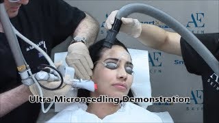 Ultra Microneedling Demonstration 19 - A E Skin - Encino, CA - 818-835-1833