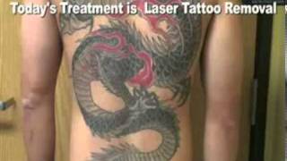 Tattoo Removal, Remove Tattoo, Tarzana, (877) 650-7267