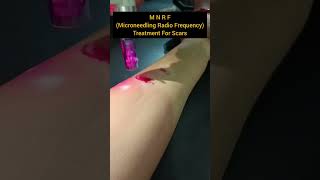 MNRF For #scars #mnrf #laser #scartreatment #skincare #shorts  #cabincrew #cabincrewjobs