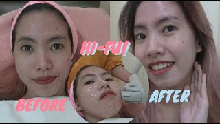 V-SHAPE MY HIFU EXPERIENCE | ALAYZAMAYLAO