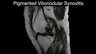 Pigmented Vilionodular Synovitis