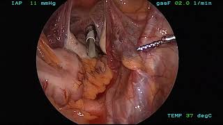 MiniLap Percutaneous System - Dermoid Cyst Removal