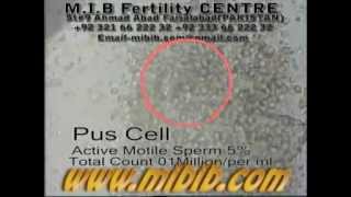 human semen active 5% with pus cells