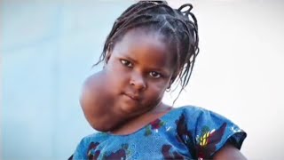 Essa menina sofria muito com um ENORME TUMOR  mas um ANJO apareceu em sua vida e mudou  seu destino