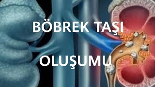 BÖBREK TAŞI NASIL OLUŞUR