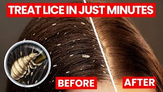 4 Effective Ways to Treat Lice Without Chemicals