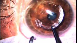 Intralase (iFS) Assisted Keraring Implantation for Keratoconus.