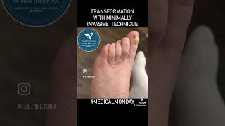 #medicalmonday #transformation of painful contracted #hammertoe with #minimallyinvasive #checkitout