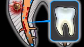 Root Canal Treatment Complications - Risks