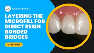 Layering the Microfill for Direct Resin Bonded Bridge with Dr. Dennis Hartlieb | DOT Course Clip