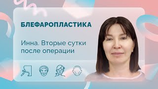 Инна. Блефаропластика. 2 сутки