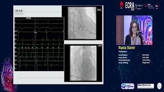 Ablation of Difficult Accessory Pathwaays   Dr  Rania Samir