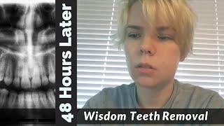 48hrs Wisdom Teeth Extraction Aftermath - What to Expect