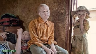 Miris..!! Potret kehidupan Albino Afrika yang mengenaskan..