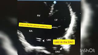 4 chamber view - UVC in RA entering LA. UAC in Descending aorta