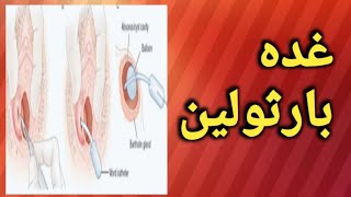 علاج غده بارثولين بدون أدوية/وما هي وأسبابها وطرق علاجها/تجربتي الاعراض والعلاج وهل هي خطير