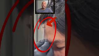 They Unplugged His Forehead and It Drained (New Facial) #shorts #randomvideo #shocking