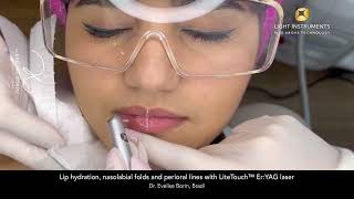 Lip hydration with LiteTouch™ Er:YAG laser