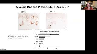 Medical Advisory Board Town Hall  Dermatomyositis   Interstitial Lung Disease   AntiSynthetase Syndr