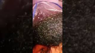 How Surgeons Remove Gastric Hair Ball | Laparoscopic Removal of a Large Gastric Trichobezoar #shorts