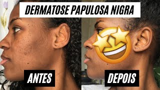 DERMATOSE PAULOSA NIGRA | Tratamento com ELETROCAUTERIZAÇÃO!